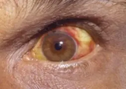 Conjunctival suffusion of the eyes due to leptospirosis